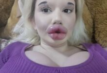 صاحبة أكبر شفاه في العالم: أعجبني كثيرًا وأرغم في المزيد من عمليات التجميل