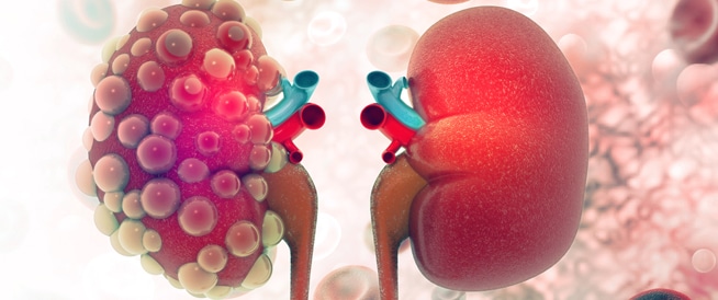 "القاتل الصامت"... علامات غير مباشرة تدل على تسمم الكلى