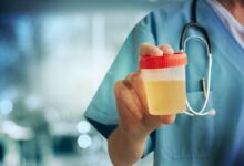 7 أطعمة ومشروبات قد تسبب عكرًا في البول